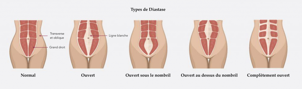 Qu'est-ce que la diastase des grands droits ?
